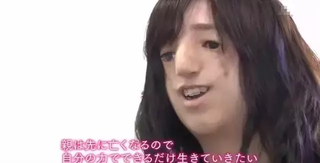 日本面部缺陷的無臉妹,被嘲笑為「怪物」,卻依然活得堅定溫柔!