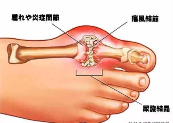 醫生提醒:尿酸高的人,多喝1種水,少吃2種食物,不花錢排尿酸 !