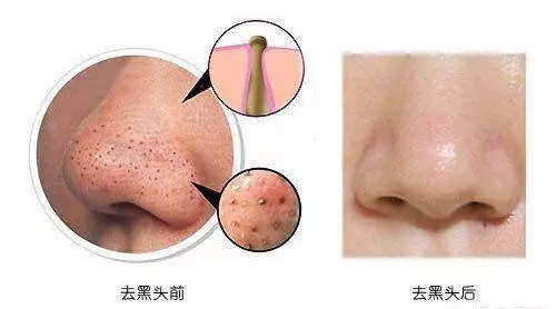 鼻子上黑頭去不掉?教你1個去黑頭妙招,輕輕一抹,黑頭全出來 !