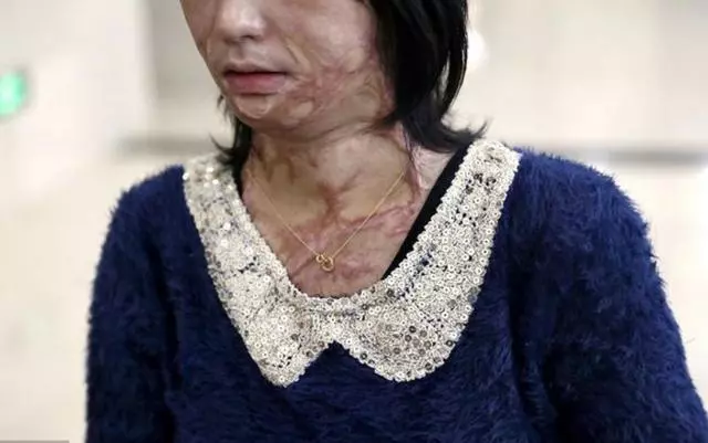 家裡太窮娶不起老婆,只能娶個毀容的醜女人,結婚後我發現我錯了
