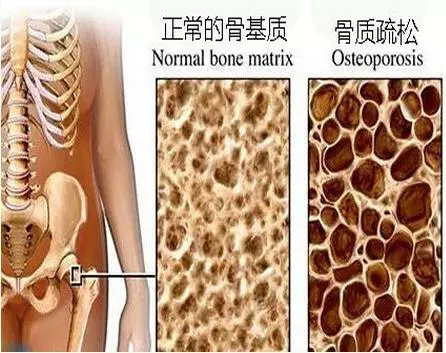 骨質疏鬆不用怕,這些治療方法你用了嗎?