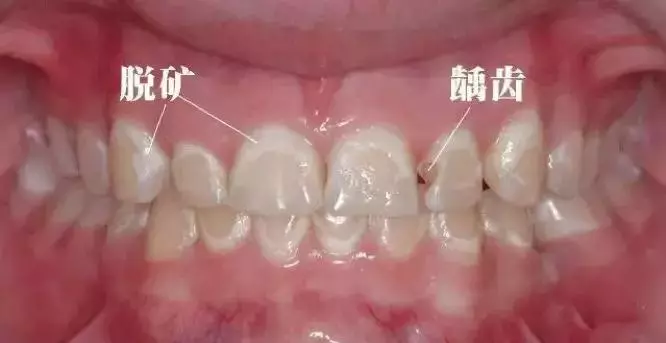 花草茶、咖啡、運動飲料,比紅茶香菸可樂更傷牙齒!