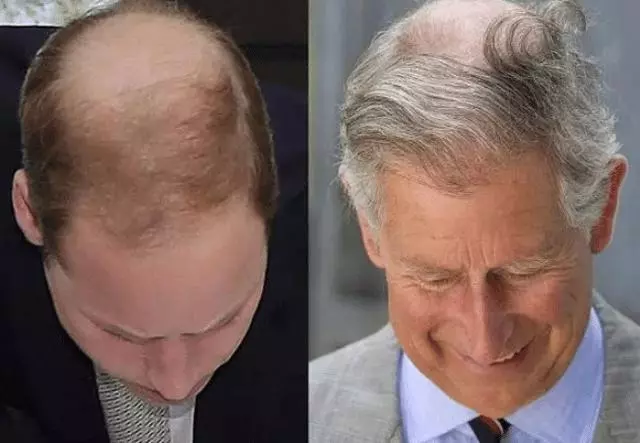 為什麼健身肌肉男里這麼多光頭,力量訓練是導致脫髮的原因嗎?