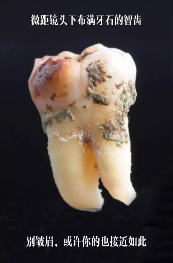 牙縫裡的髒石頭又腥又臭?日常生活中用這幾招,不用洗牙也能應對!