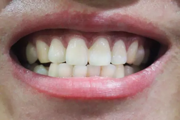 刷牙的時候,經常出血疼痛是為啥?如何刷牙才更健康?