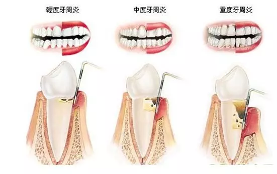 牙齒鬆動,頭號殺手——牙周炎