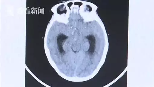 「小感冒」卻變腫瘤…男童昏迷險喪命