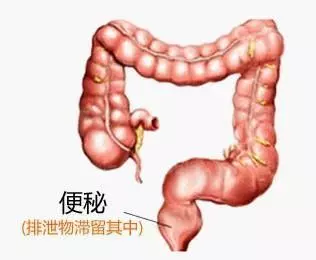 便秘好幾天沒有大便,糞便都去哪裡了?醫生告訴你治療方案