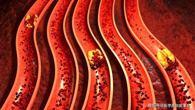 血管狹窄的人,睡覺時往往有四個表現,若全部都有,提示該檢查了!