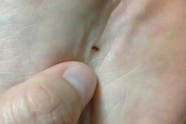 人身上的痣,不一定都是好的!哪些痣需要當心?