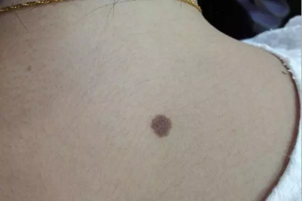 人身上的痣,不一定都是好的!哪些痣需要當心?