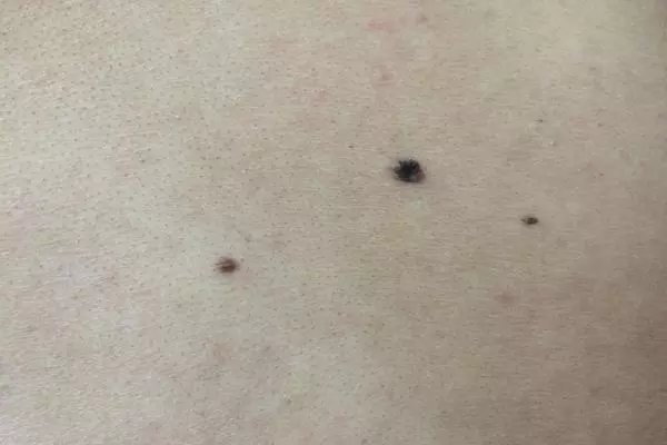 人身上的痣,不一定都是好的!哪些痣需要當心?