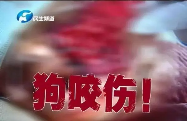 阿嬤牽他到鄰居家 1歲童被狗咬掉半邊臉