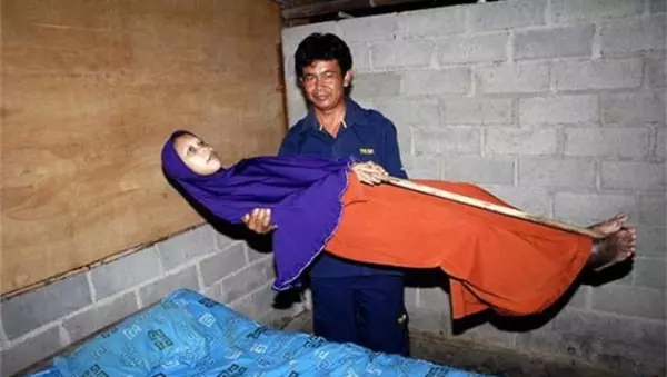 35歲婦女染上可怕怪病,10年來身體硬梆梆無法彎腰,成了當地聞名的「殭屍女」!