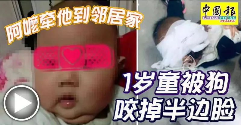 阿嬤牽他到鄰居家 1歲童被狗咬掉半邊臉