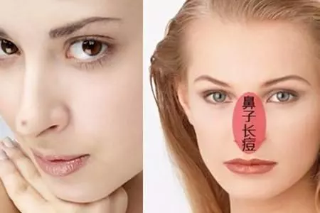 不同位置長痘揭示著身體哪些問題?對照一下