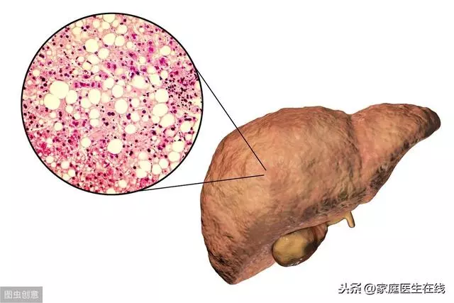 脂肪肝不是什麼大病?不及時治療,身體會遭受傷害