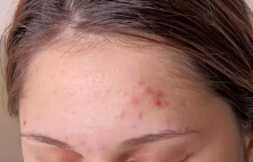 人為什麼會長痘痘?營養師:長痘痘的人,2種食物都不要多吃了