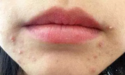 人為什麼會長痘痘?營養師:長痘痘的人,2種食物都不要多吃了