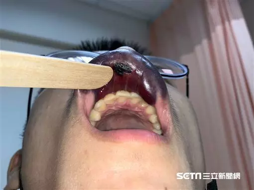 嚇!男大生打籃球遭肘擊 慘變「香腸嘴」腫翻天 | 生活 | 三立新聞網 SETN.COM