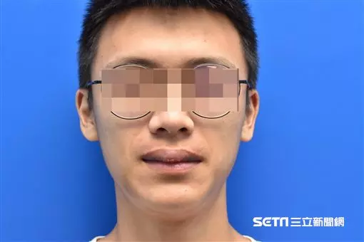 嚇!男大生打籃球遭肘擊 慘變「香腸嘴」腫翻天 | 生活 | 三立新聞網 SETN.COM