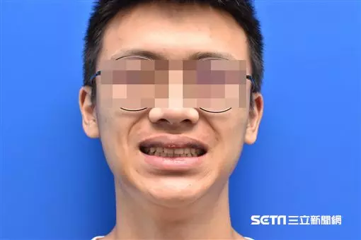 嚇!男大生打籃球遭肘擊 慘變「香腸嘴」腫翻天 | 生活 | 三立新聞網 SETN.COM