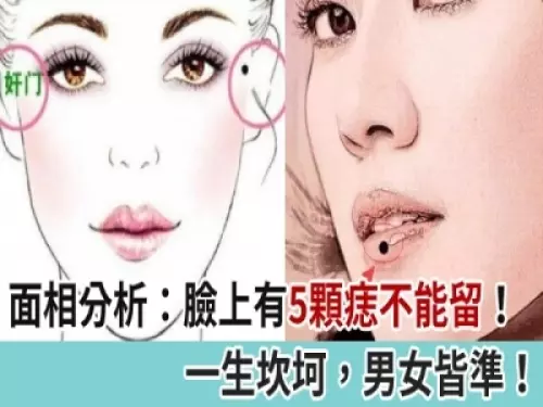 面相分析:臉上有5顆痣不能留!一生坎坷,男女皆準!